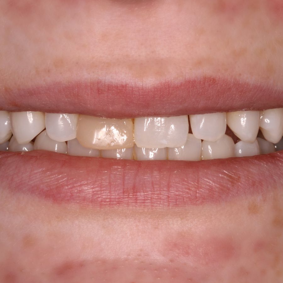 dental bonding - before -3dental